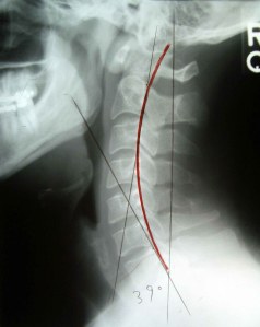 Cervical Curve